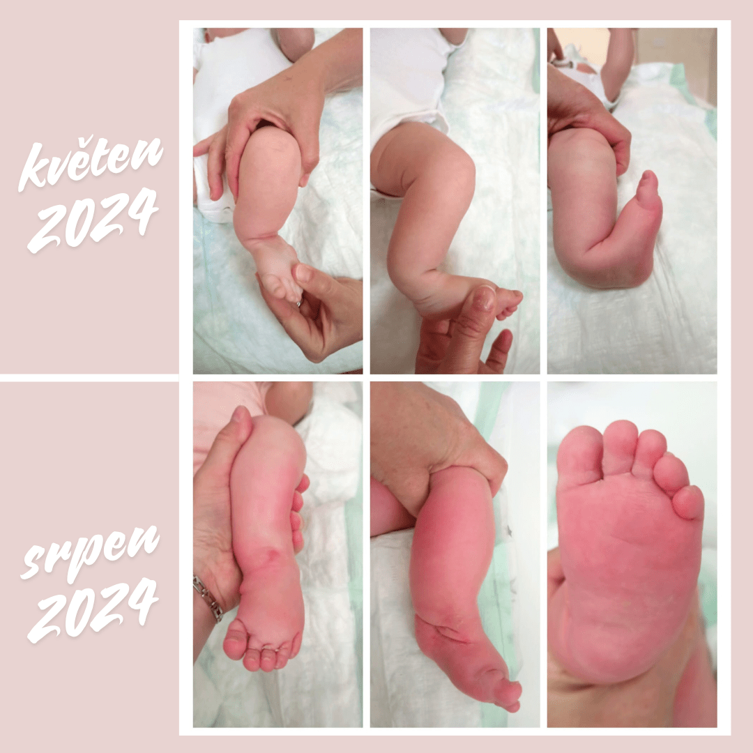 Ponseti metoda před a po